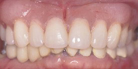 The image shows a close-up view of a person s teeth with a focus on a dental implant, showcasing its integration into the surrounding natural teeth.