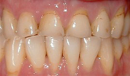 The image displays a close-up view of a person s mouth with yellowed teeth, showing signs of dental decay or discoloration.